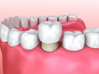 dental crowns Gold Coast