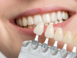 porcelain dental veneers