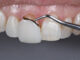 veneers composite