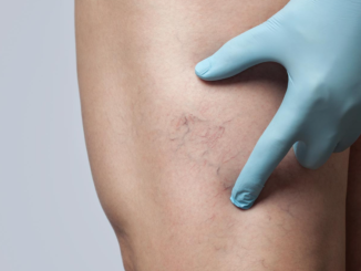 spider vein removal in Sydney
