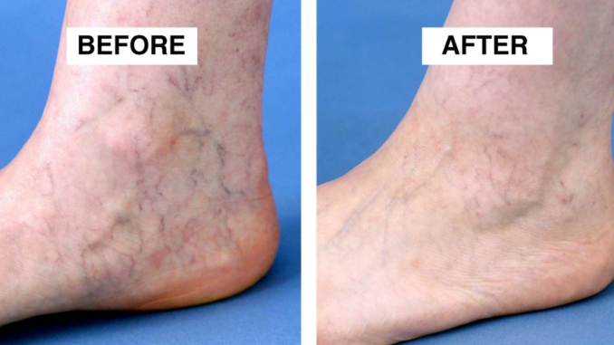 vein removal in Sydney