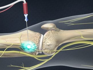 radiofrequency thermal ablation