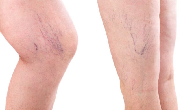 varicose vein clinic