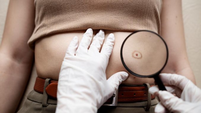 umbilical hernia surgeon