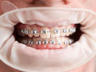 Orthodontics in Ottawa