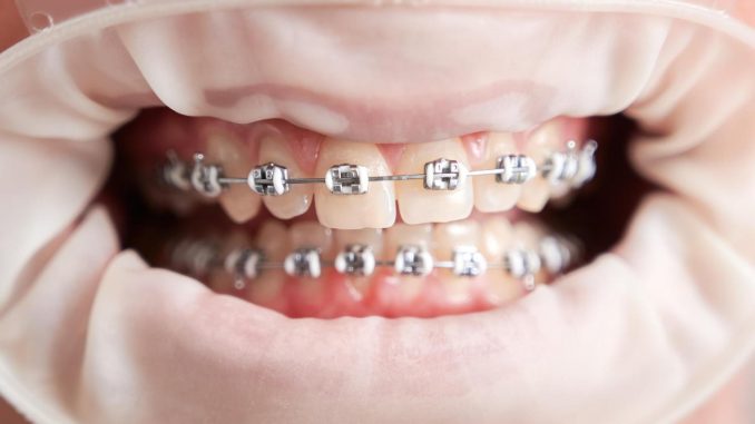 Orthodontics in Ottawa