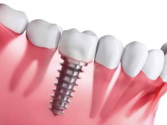 Hughson Dental Implants