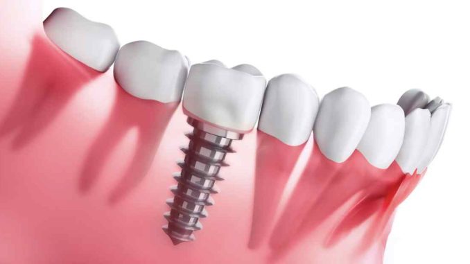 Hughson Dental Implants