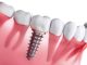 Hughson Dental Implants