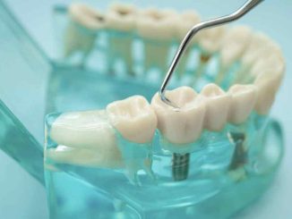 Hughson Dental Implants