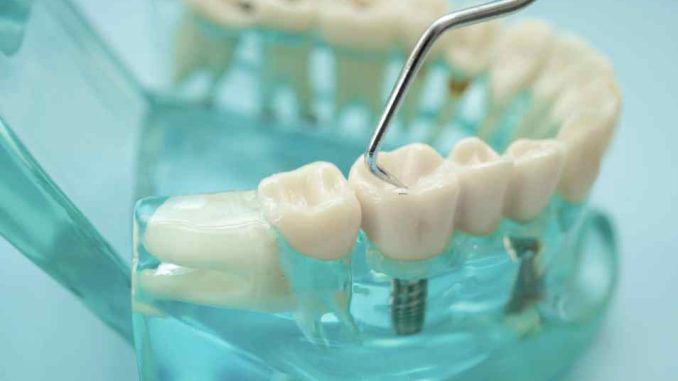 Hughson Dental Implants